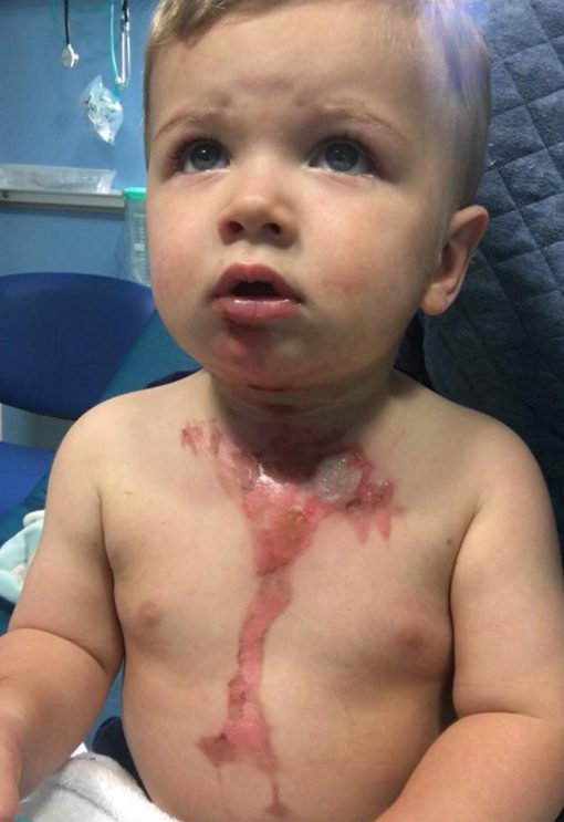 When Your Baby Burns With Hot Tea First Aid Steps To Soothe The Pain