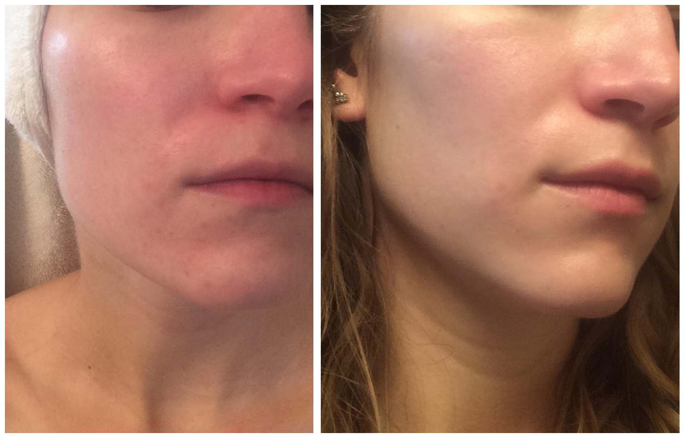 Perioral Dermatitis Causes Symptoms And Treatment KidsAcookin