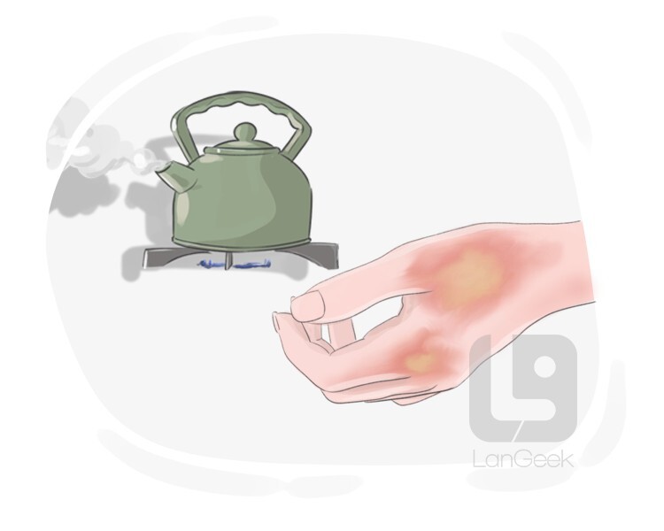 Definition & Meaning of "Scald" LanGeek