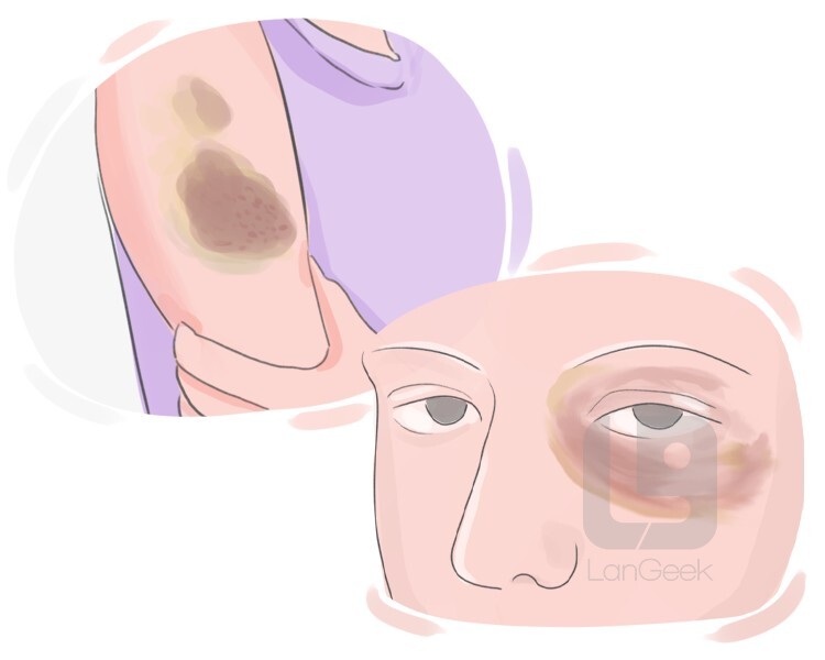 Definition & Meaning of "Black and blue" LanGeek