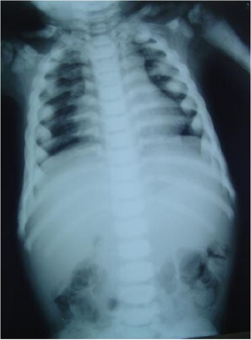 Osteogenesis Imperfecta Concise Medical Knowledge