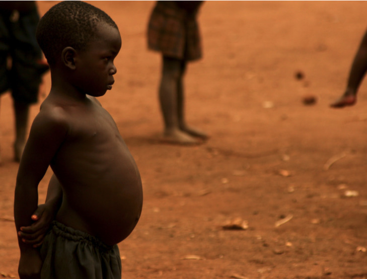 Malnutrition in children in resourcelimited countries Concise