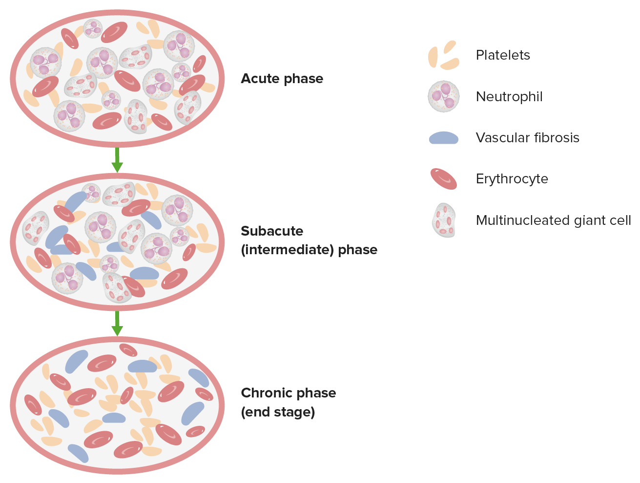 Thromboangiitis Obliterans (Buerger’s Disease) Concise Medical Knowledge