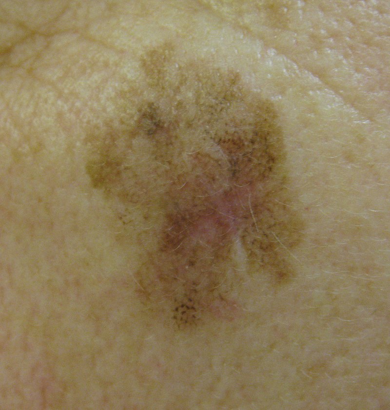 Lentigo Maligna Concise Medical Knowledge