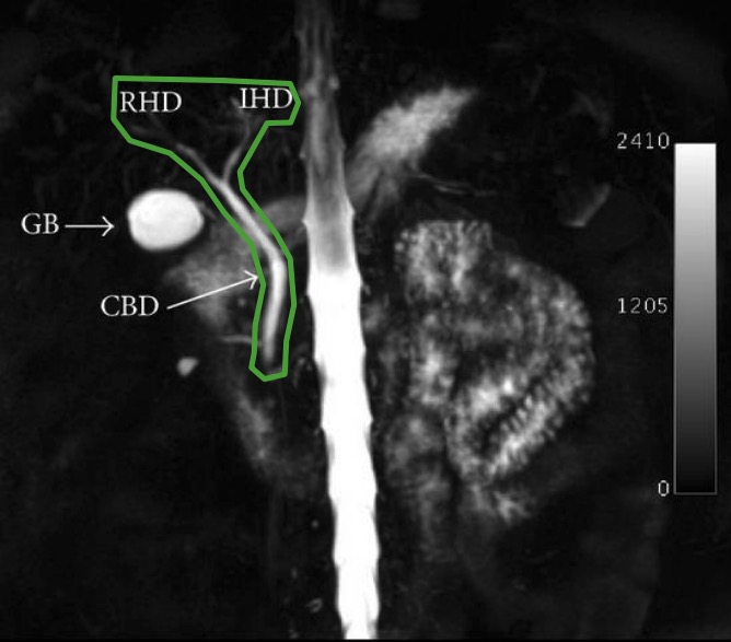 Primary Sclerosing Cholangitis Concise Medical Knowledge