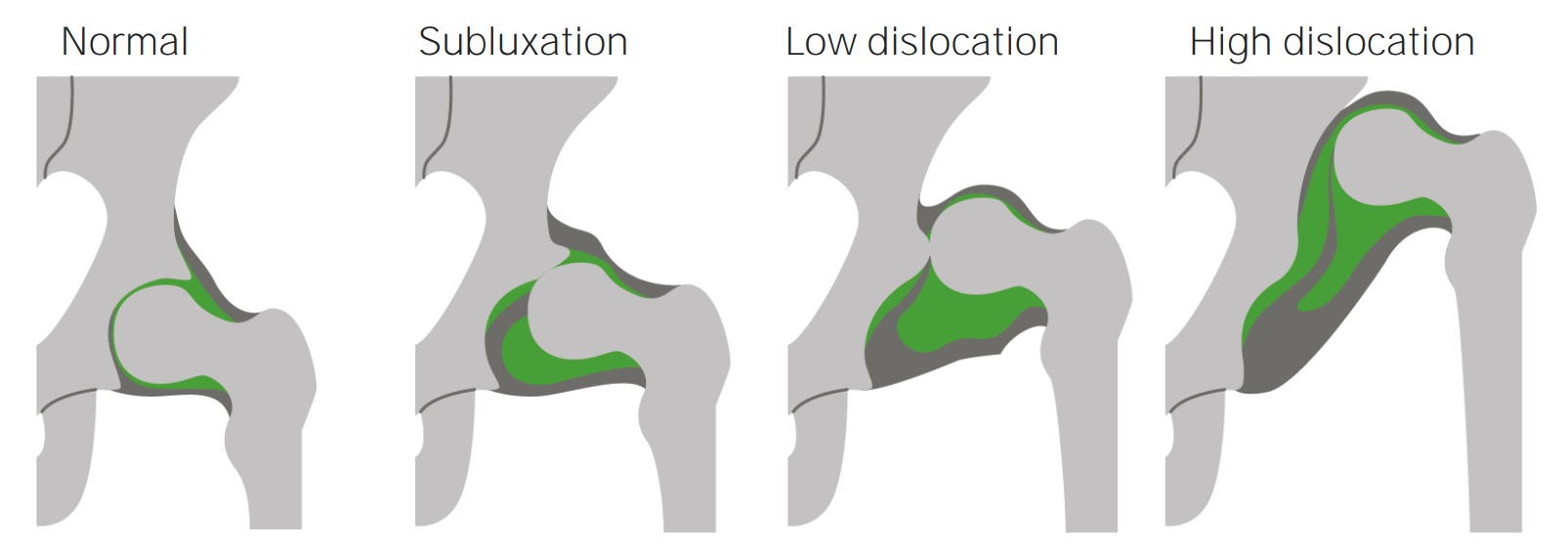 Developmental Dysplasia of the Hip Concise Medical Knowledge