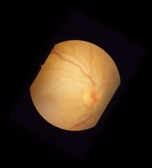 Retinal Detachment Concise Medical Knowledge