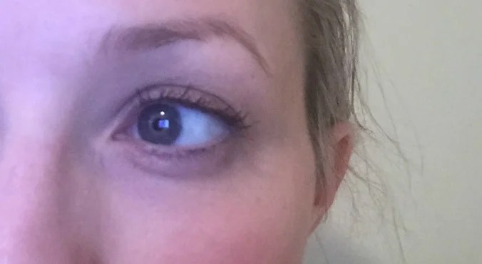 Women are using haemorrhoid cream to treat under eye bags.