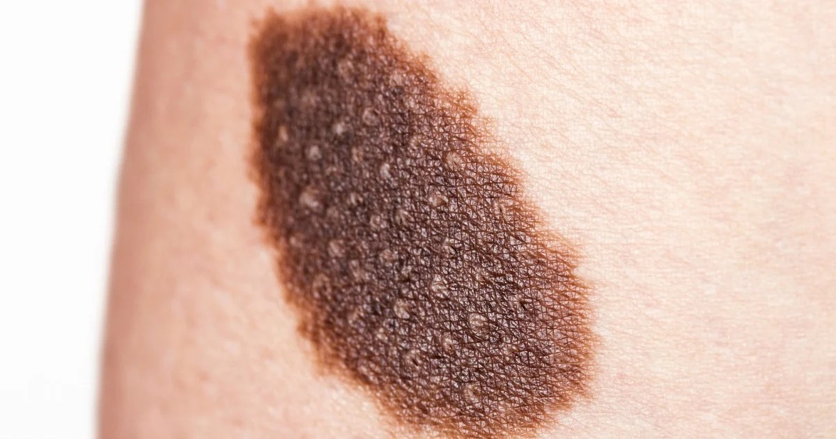 Common Lumps And Bumps: What Are They?