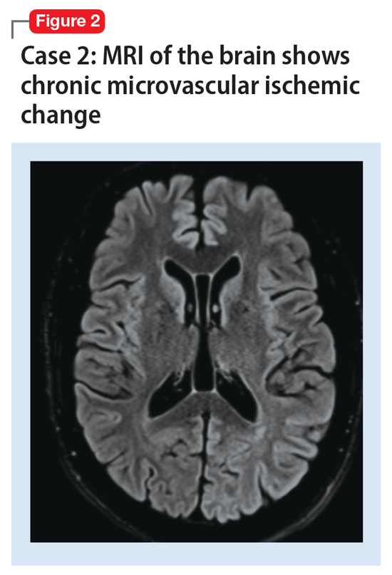 Olderage bipolar disorder A case series MDedge Psychiatry