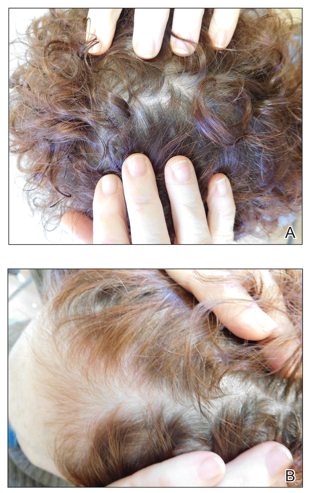 Pityriasis Amiantacea Following Bone Marrow Transplant MDedge Dermatology