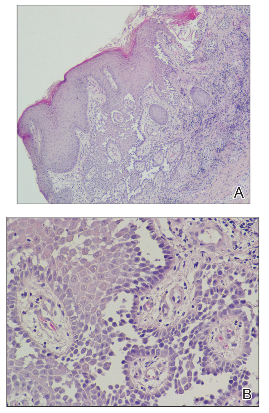 HaileyHailey Disease A Diagnostic Challenge MDedge Dermatology
