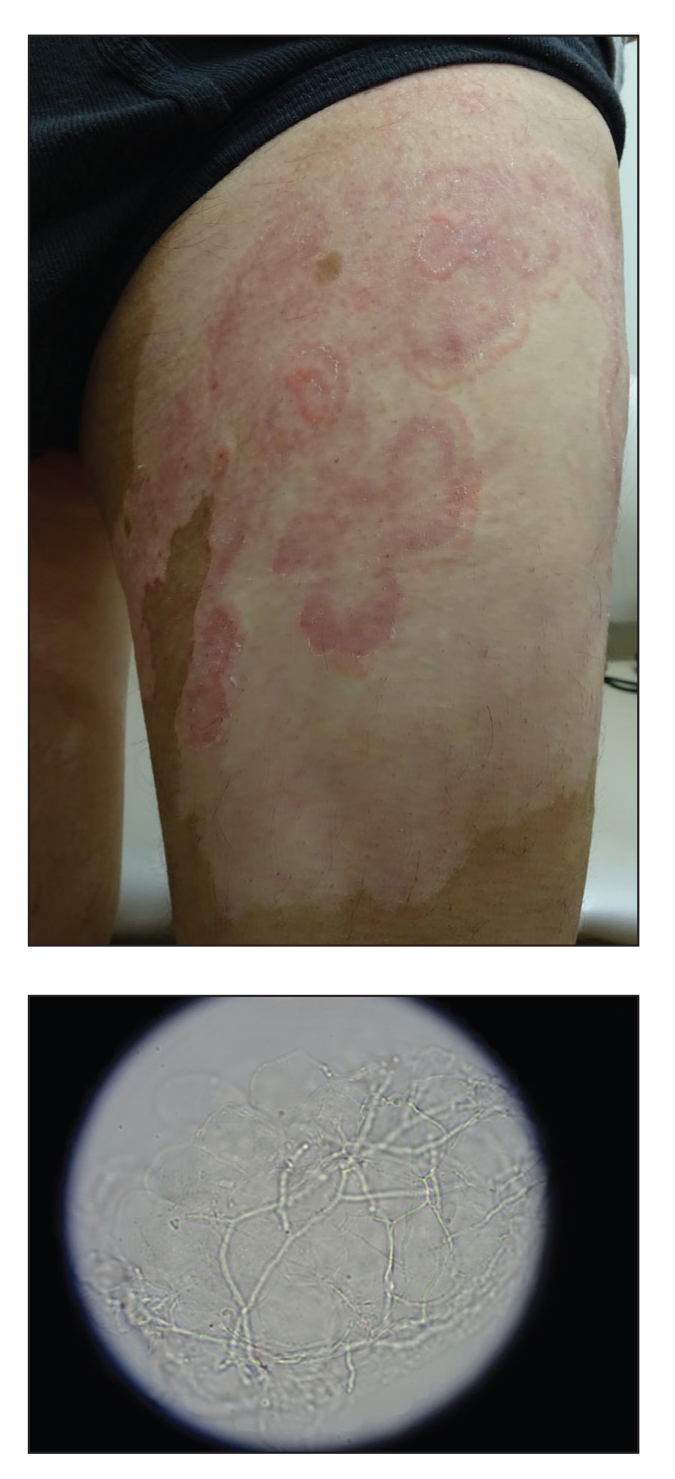 Pink, Scaly, Annular Plaques in Concentric Rings Localized to