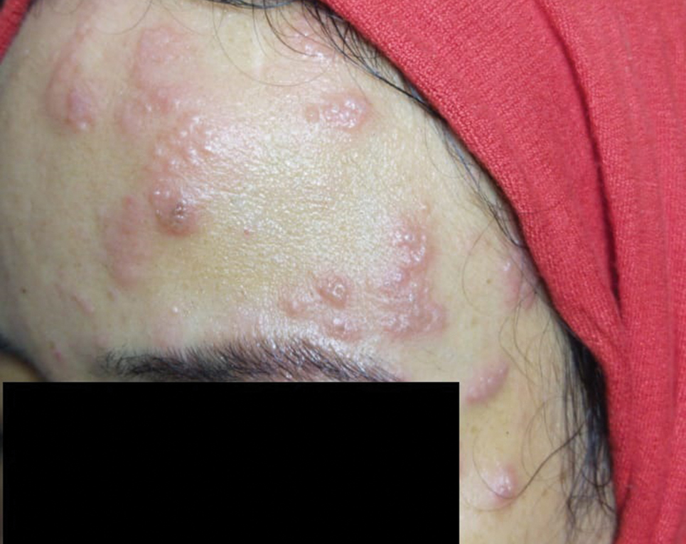 Herpes Zoster May Be a Marker for COVID19 Infection During Pregnancy