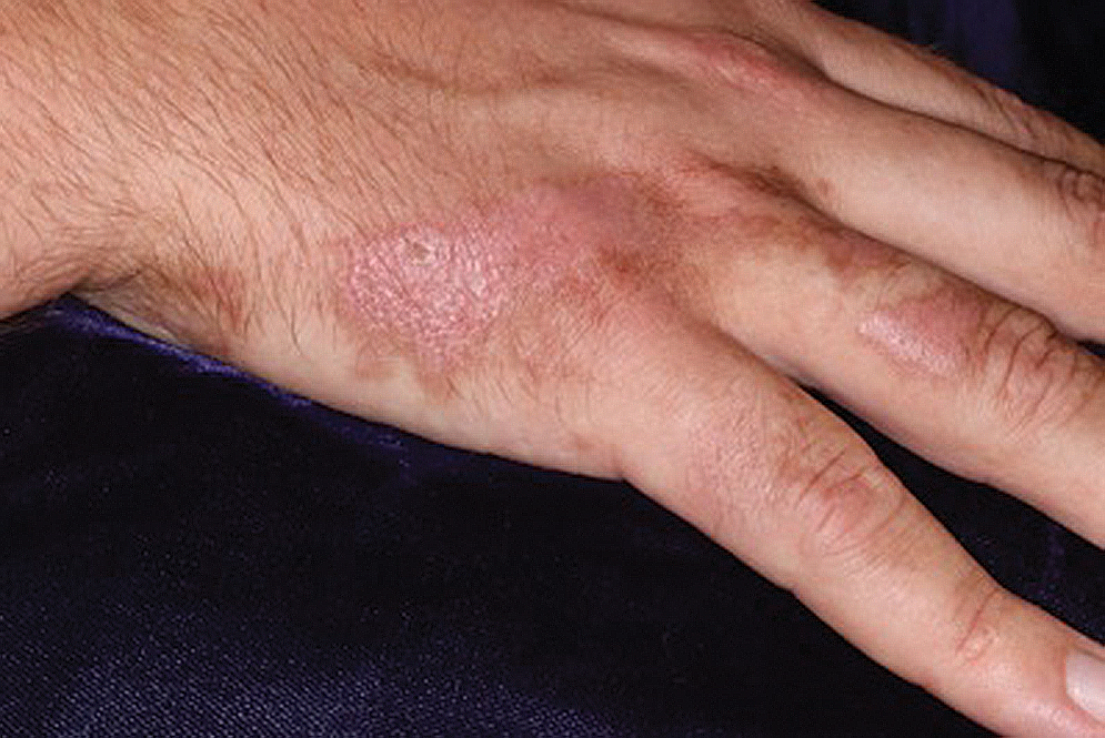 Pink Patches With a Hyperpigmented Rim MDedge Dermatology