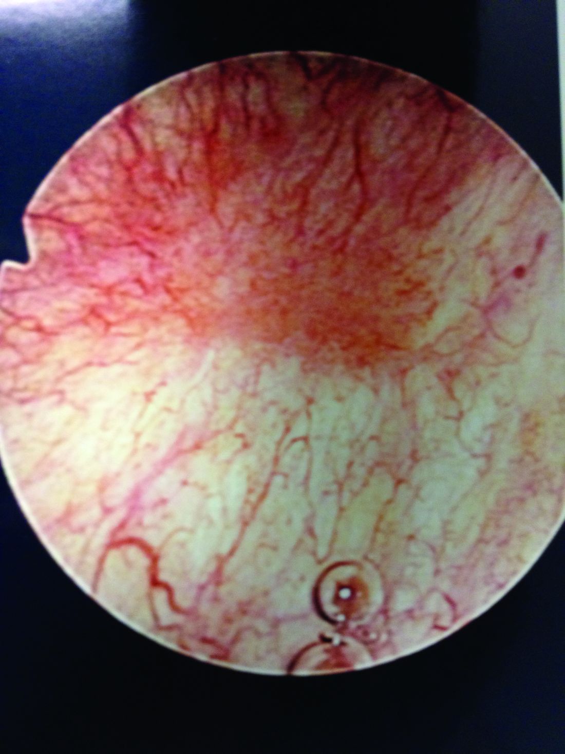 The broad picture of interstitial cystitis MDedge ObGyn