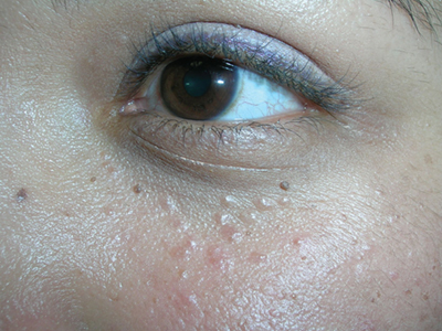 Bumps Under Eyes | Mdedge Family Medicine