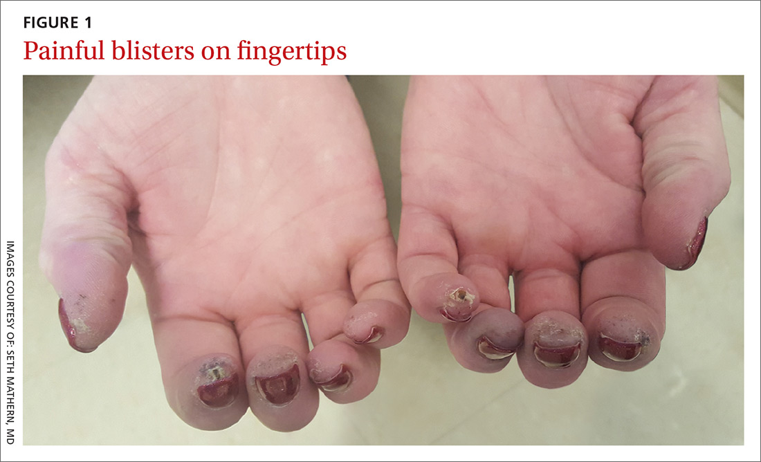Painful blisters on fingertips and toes MDedge Family Medicine