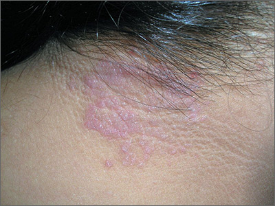 Itchy Rash On Neck | Mdedge Family Medicine