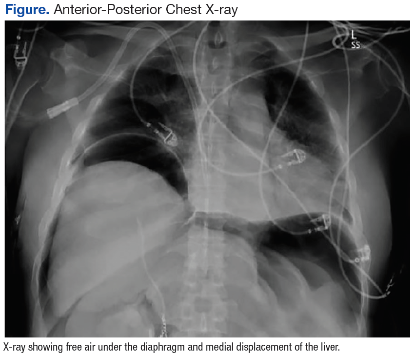 Duodenal Perforation After Endoscopic Procedure Federal Practitioner