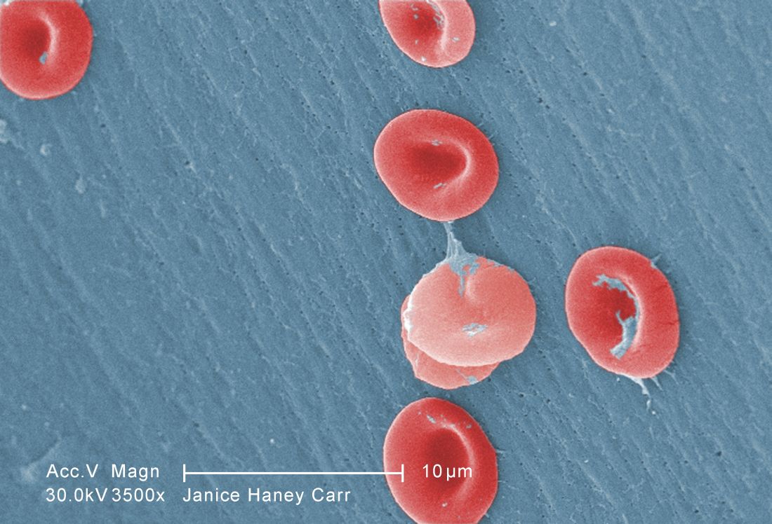 Too few Michigan children with SCD receive pneumococcal, meningococcal