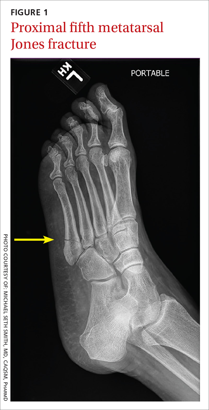 Adult foot fractures A guide MDedge Family Medicine