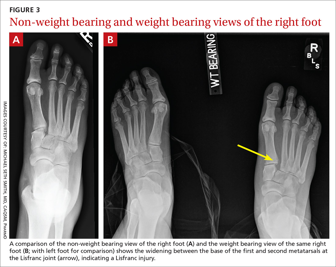 Adult foot fractures A guide Clinician Reviews