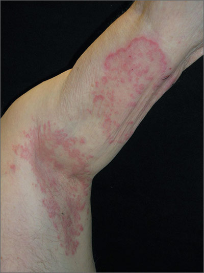 Pruritic Rash In Armpit | Mdedge Family Medicine