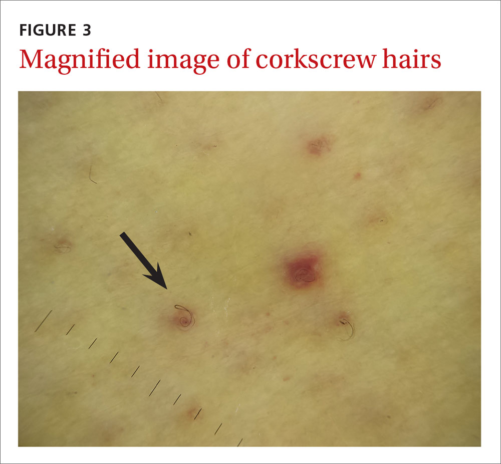 Perifollicular petechiae and easy bruising MDedge Family Medicine