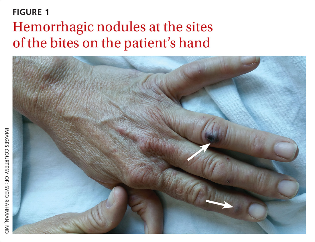 Fever, petechiae, and joint pain MDedge Family Medicine