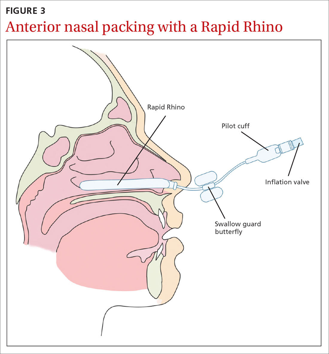 Epistaxis A guide to assessment and management Clinician Reviews