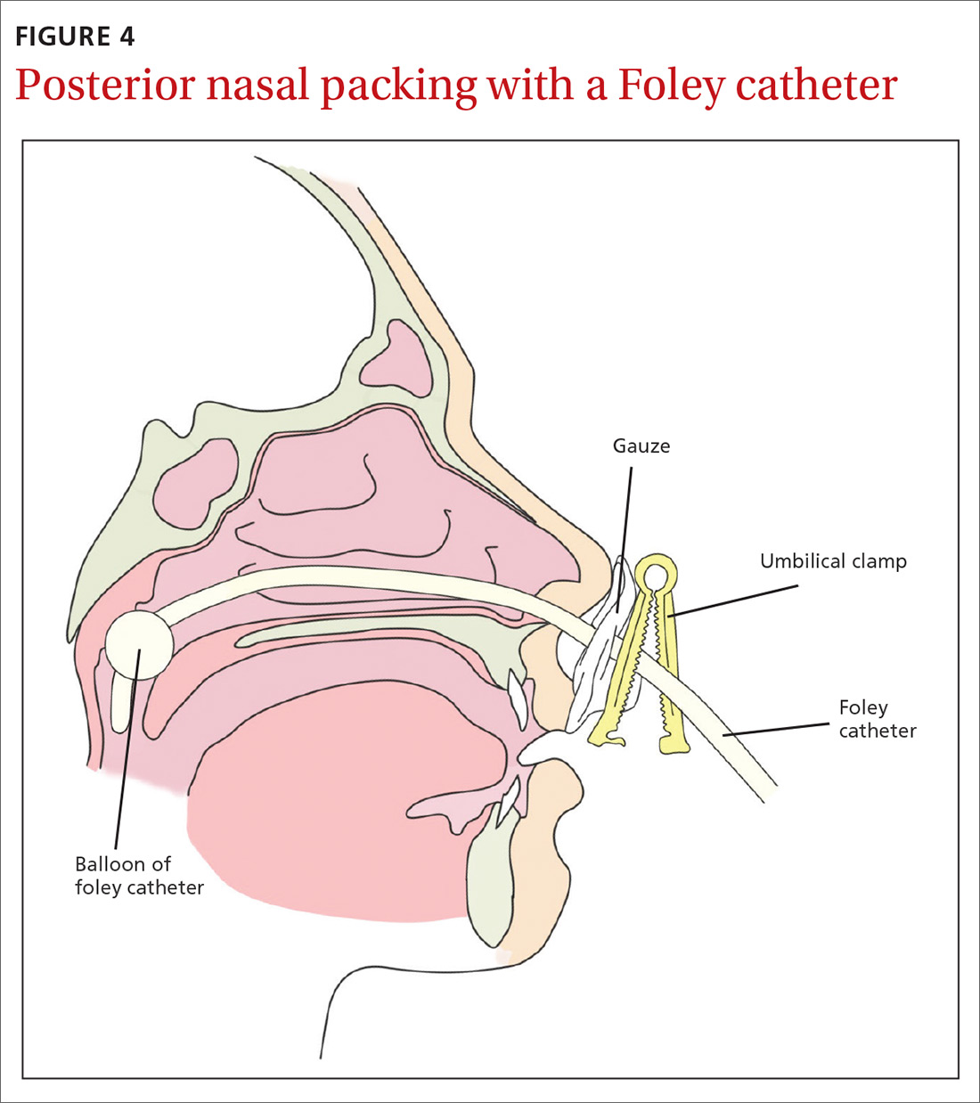 Epistaxis A guide to assessment and management MDedge Family Medicine