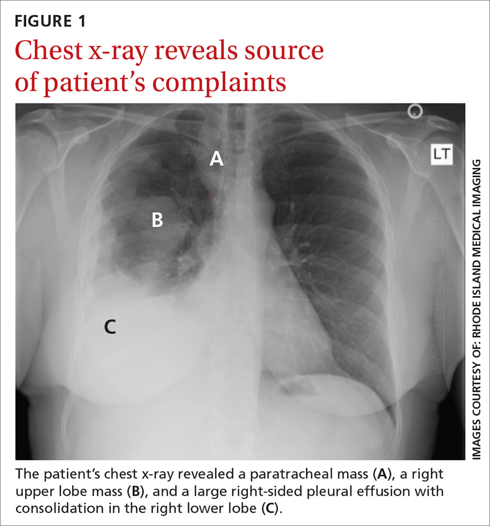 History of melanoma in situ • dyspnea • rib pain • Dx? MDedge Family