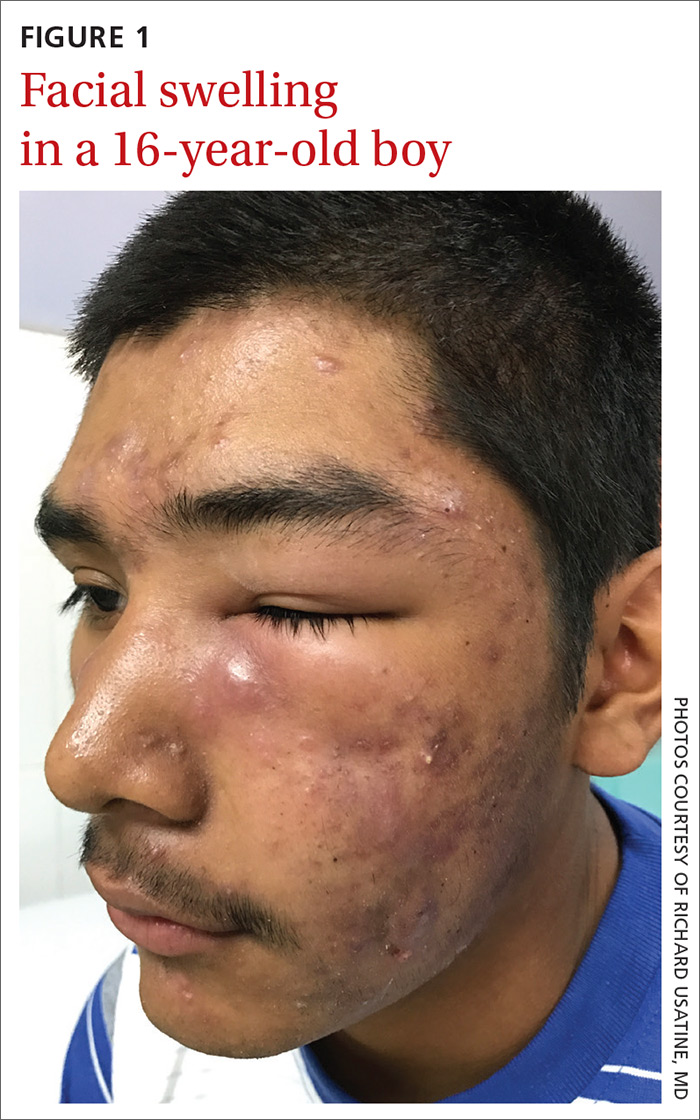 Facial swelling in an adolescent MDedge Family Medicine