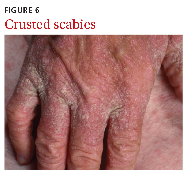 Scabies Refine your exam, avoid these diagnostic pitfalls MDedge