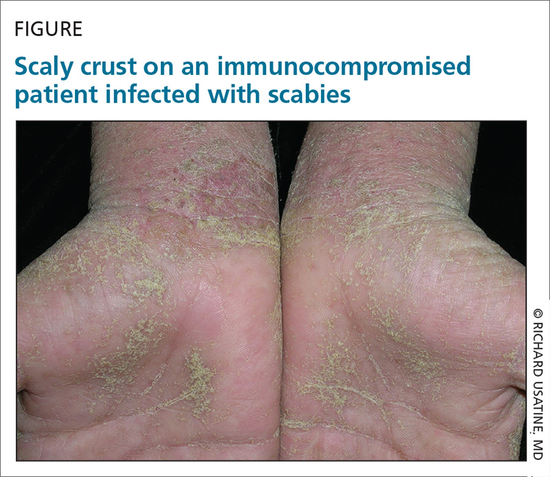 Skin Scraping For Scabies