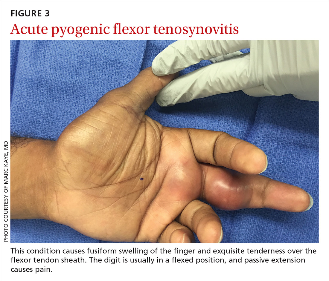 How best to approach these acute hand infections MDedge Family Medicine