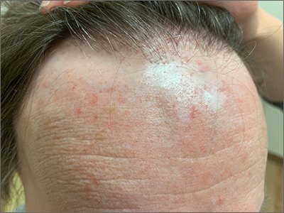 Receding Hairline | Mdedge Family Medicine