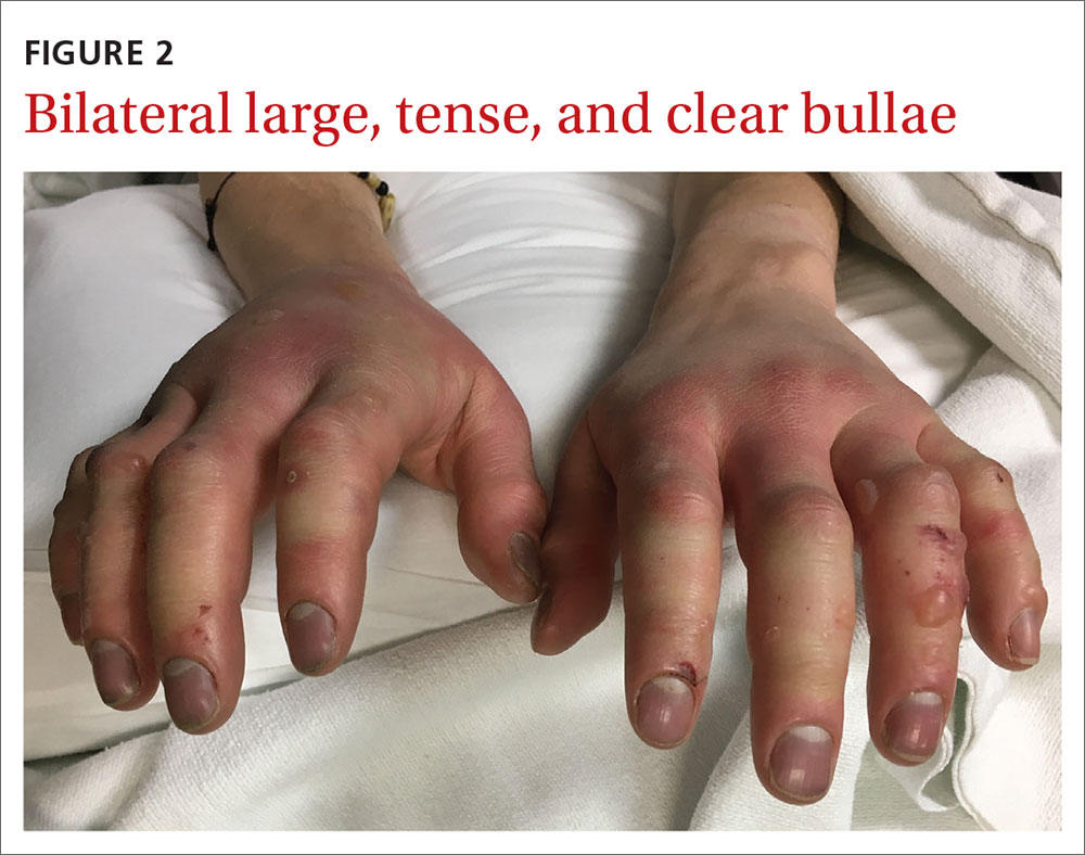 Acute bilateral hand edema and vesiculation MDedge Family Medicine