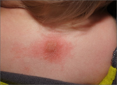 Fixed Scaly Lesion | Mdedge Family Medicine