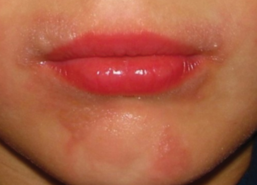 Erythematous Burning Lips Treatment