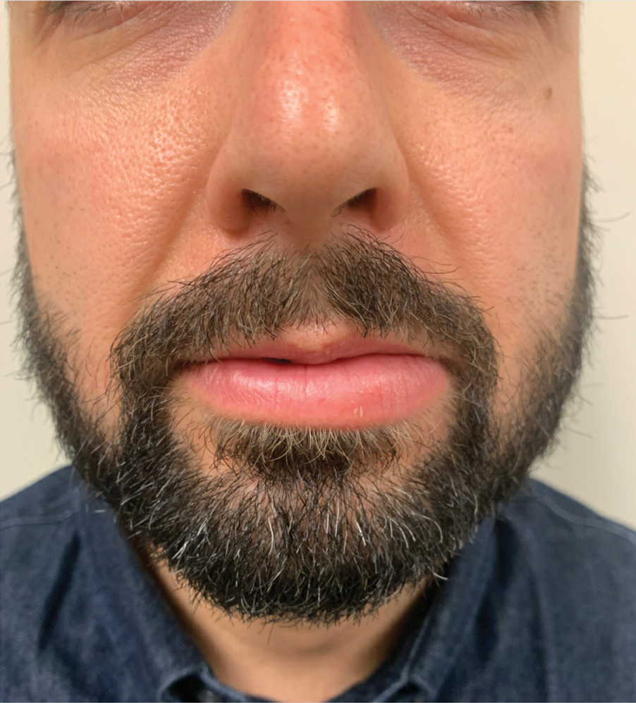 Persistent Lip Swelling MDedge Dermatology