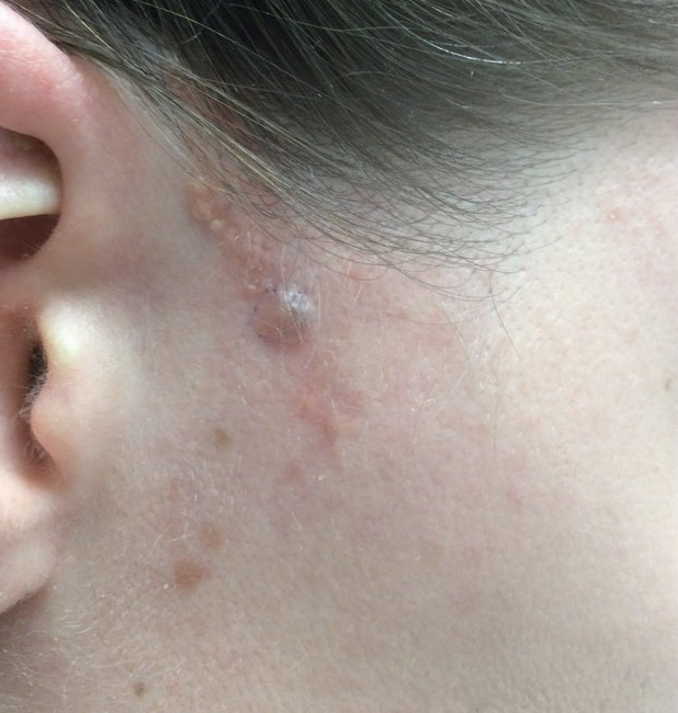 Basal Cell Carcinoma Arising in Nevus Sebaceous During Pregnancy