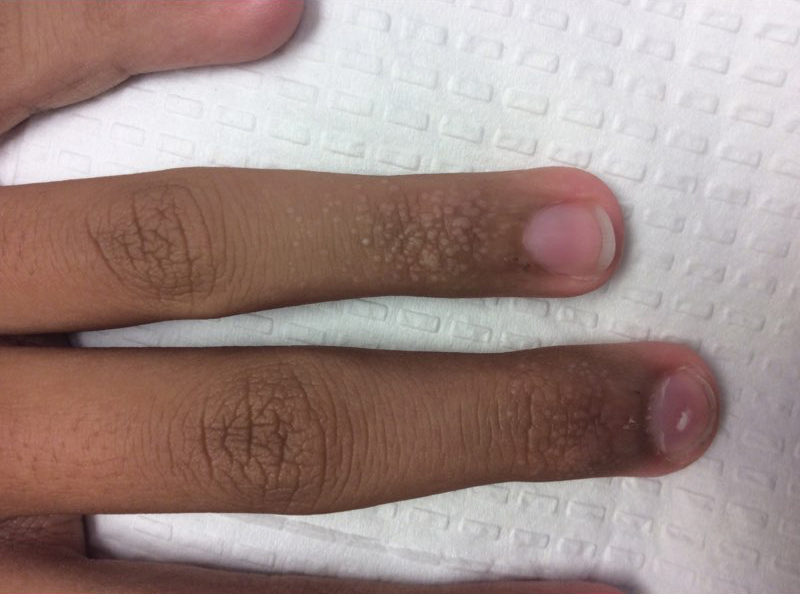 Skin Lesions On Fingers