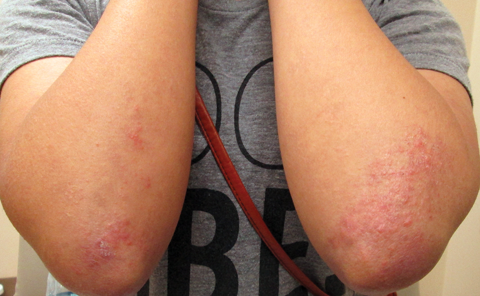 Bullous Systemic Lupus Erythematosus Successfully Treated With