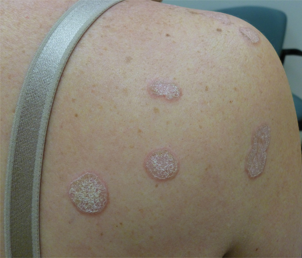 Hyperkeratotic Nummular Plaques on the Upper Trunk MDedge Dermatology