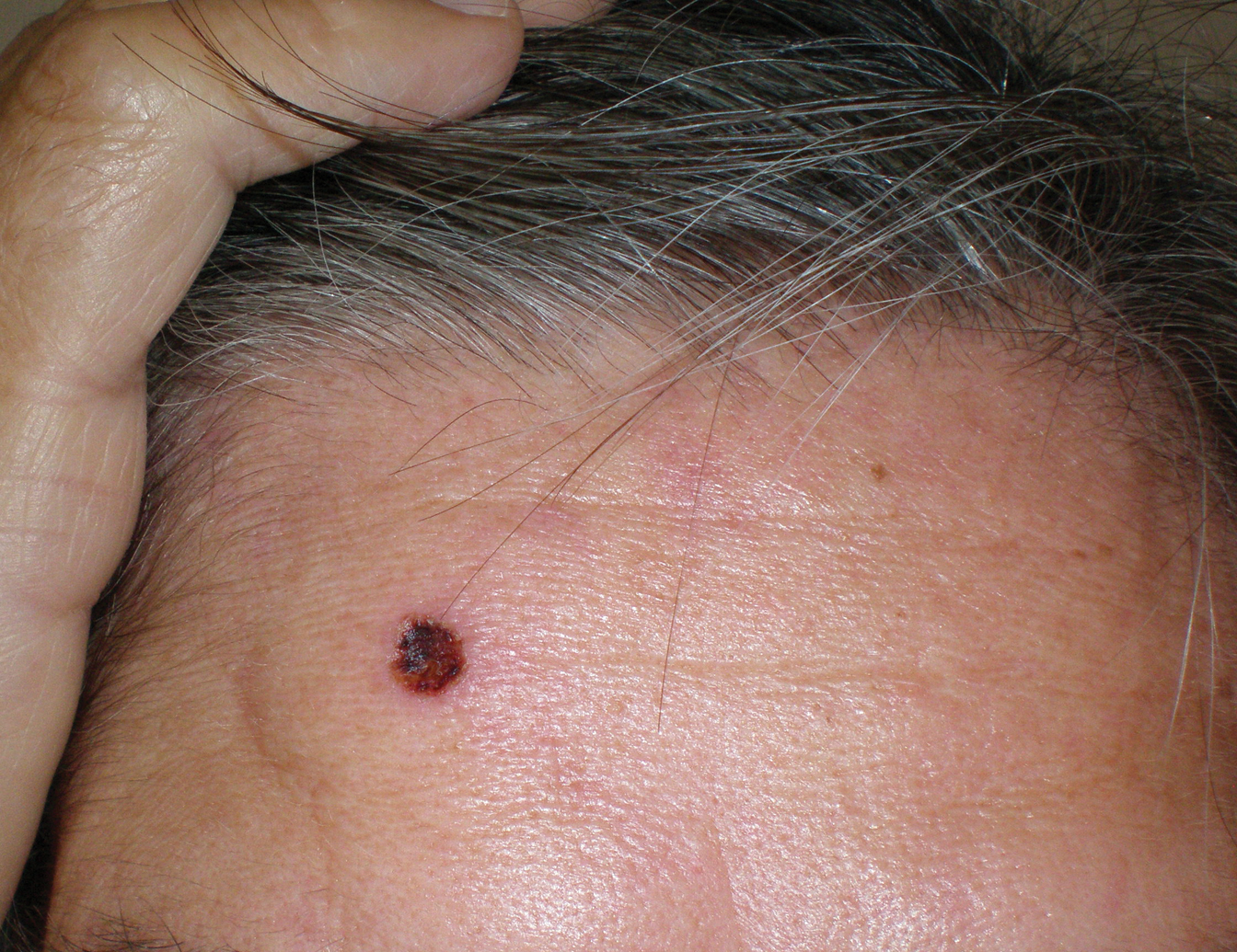 Skin Burns From Transcranial Electrical Stimulation MDedge Dermatology