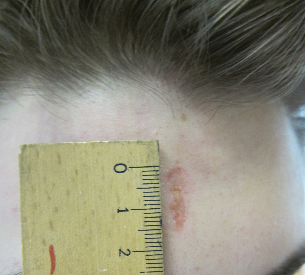 Skin Burns From Transcranial Electrical Stimulation MDedge Dermatology