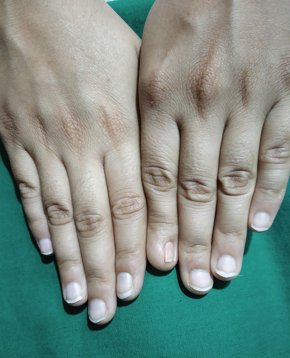 Micronychia of the Index Finger MDedge Dermatology