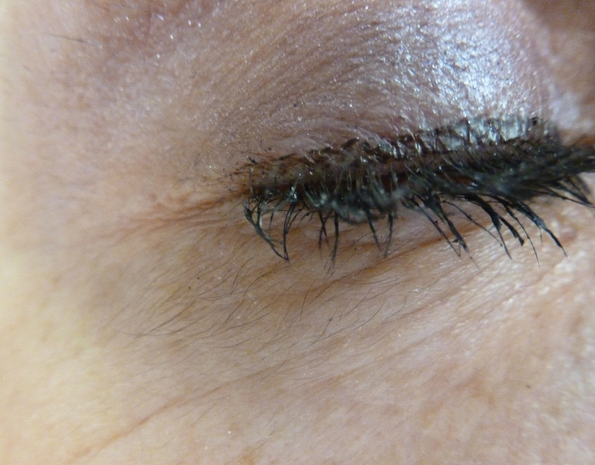 Acquired Hypertrichosis Of The Periorbital Area And Malar, 55 OFF